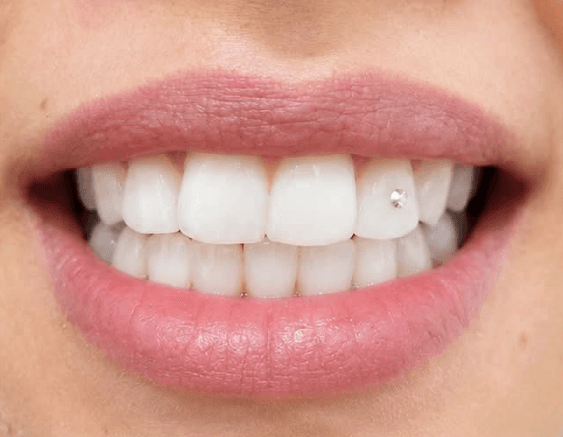 Smile results with precision
